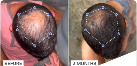 Phyne™ | Hair Growth Roll-On Serum