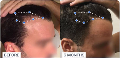 Phyne™ | Hair Growth Roll-On Serum